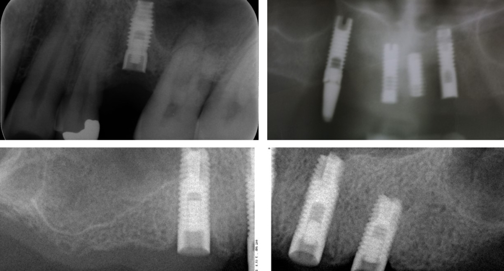 EXTRACTOR DE TORNILLOS ROTOS: CUANDO UN TORNILLO ROTO DEJA DE SER MOTIVO DE  PREOCUPACIÓN!