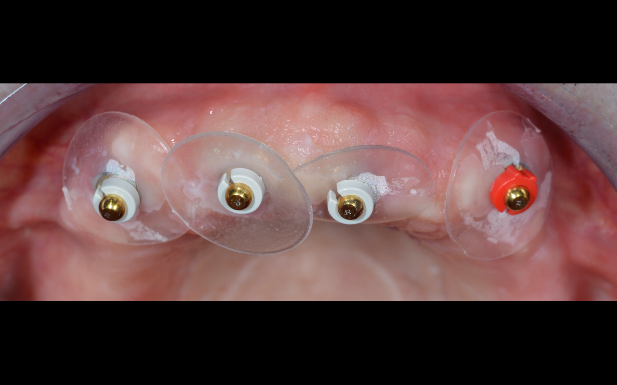 Implant retained overdenture with Ball Attachments Rhein83