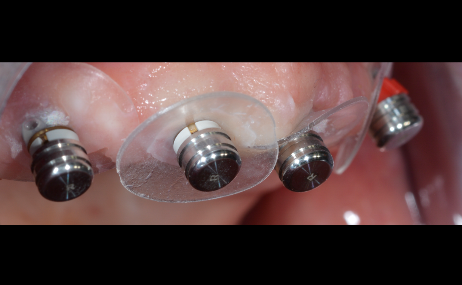 Implant retained overdenture with Ball Attachments Rhein83