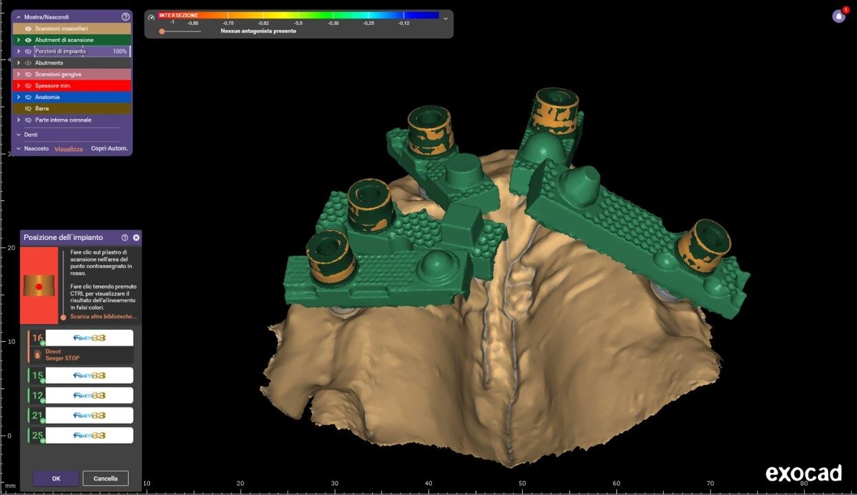 Screenshot of dental implant planning in Exocad: green implant components arranged on a beige jaw model with left tool panels visible.