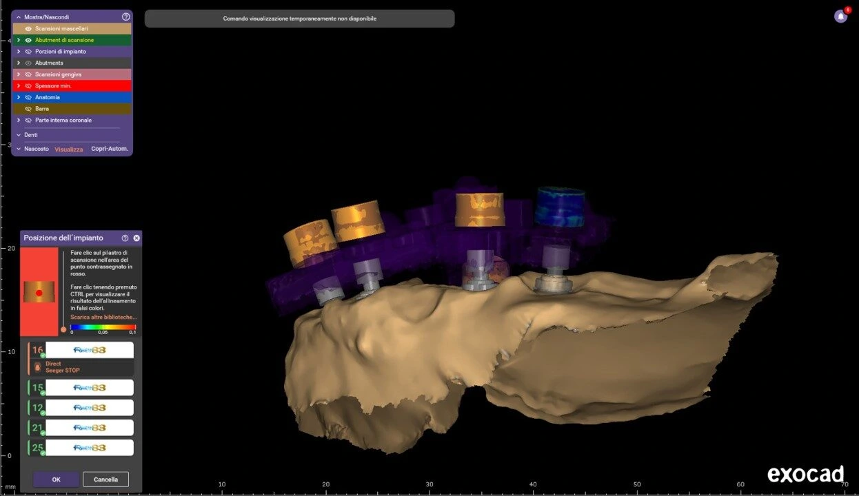 3D dental implant planning view showing a jaw model with multiple colored implants and a left tool panel in exocad software.