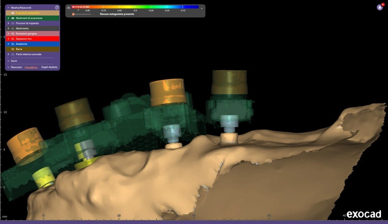 3D dental implant planning scene in Exocad, showing multiple colored implants positioned in a jawbone model